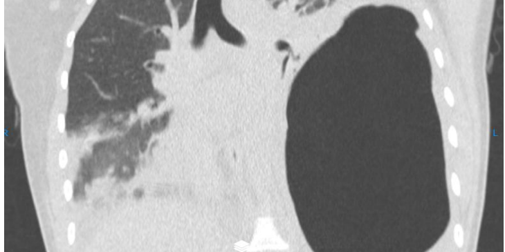 cyst cat Echinococcus
<span class="bsf-rt-reading-time"><span class="bsf-rt-display-label" prefix="დრო:"></span> <span class="bsf-rt-display-time" reading_time="2"></span> <span class="bsf-rt-display-postfix" postfix="წთ."></span></span><!-- .bsf-rt-reading-time -->